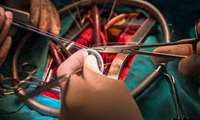 نجات جان بیمار 80 ساله با تکنیک جدید تعویض دریچه قلب